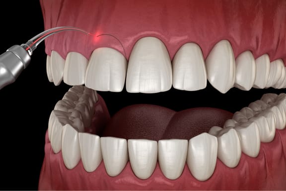 Close up animation of soft tissue laser shaping gums in mouth