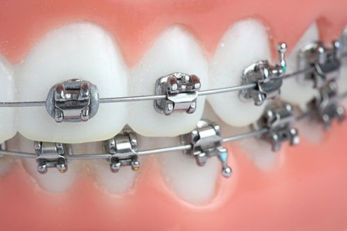 Metal Braces