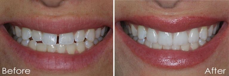 Before & After Smile