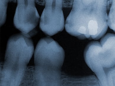 Film X-Ray of teeth